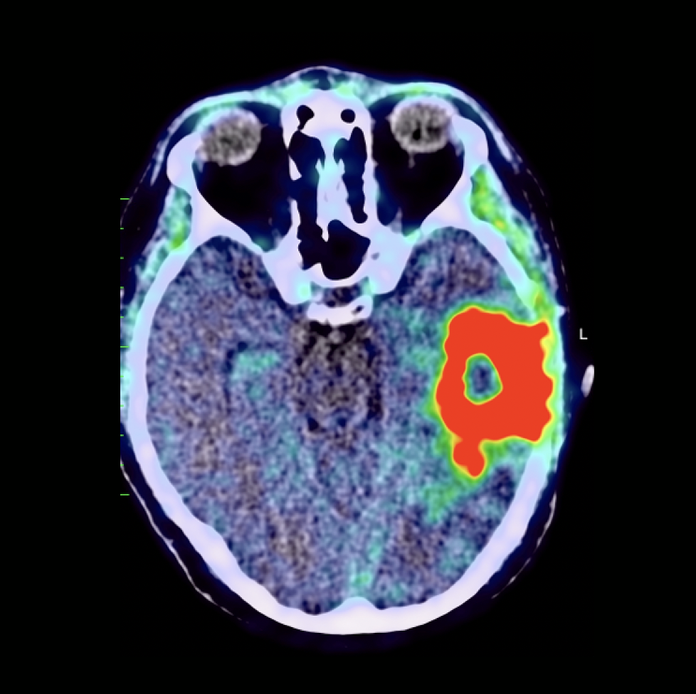 Brain Cancer Telix Pharmaceuticals